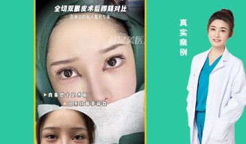 全切双眼皮术后即可对比