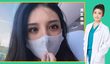 任海燕医生-黄金媚眼重睑术效果