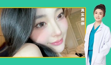 黄金媚眼重睑术效果【2】