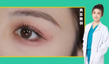 任海燕医生-眼综合双眼皮效果